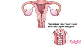 Молочница у женщин – симптомы, причины, лечение и диета